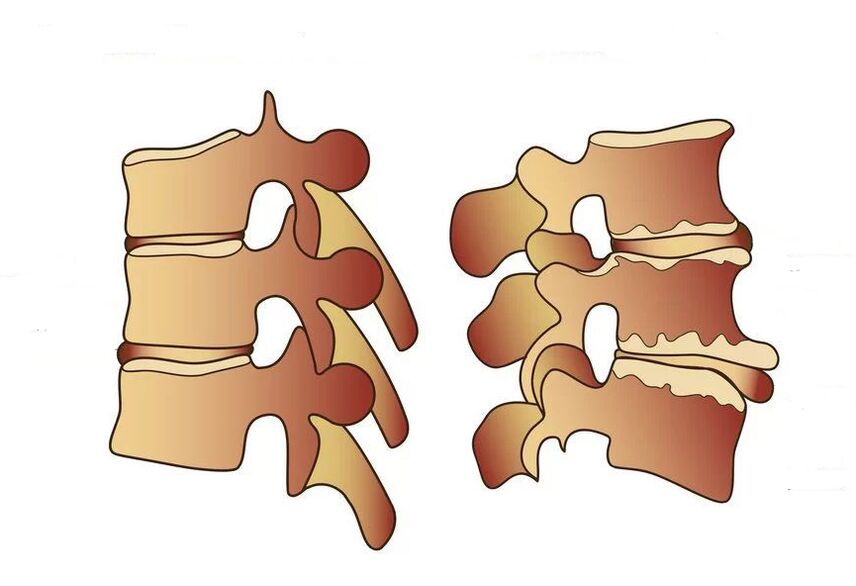 colonna vertebrale sana e malata