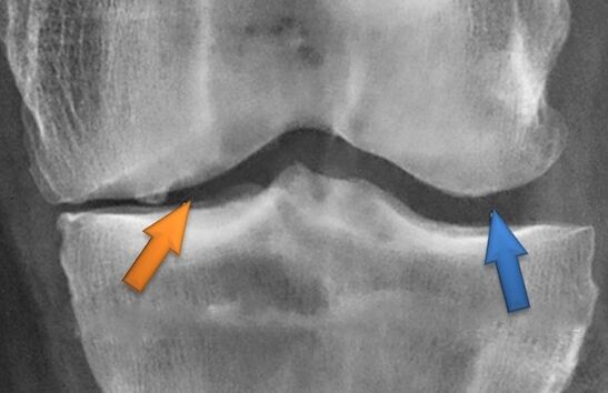 Kineteithetorapie per osteoartrite